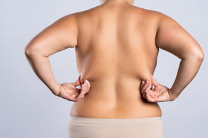 Foto mostra pessoa pegando em gordura nas costas
