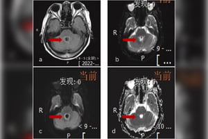 tomografia computadorizada da Chinesa morre por ameba comedora de cérebro rara