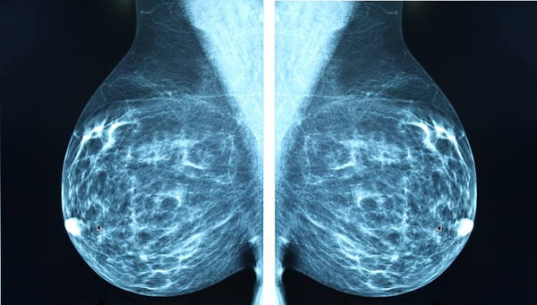 cancer de mama mamografia