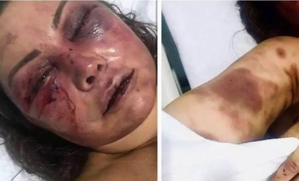 A paisagista Elaine Peres Caparroz ficou com o rosto desfigurado apos ser agredida pelo lutador de jiu-jitsu Vinicius Serra