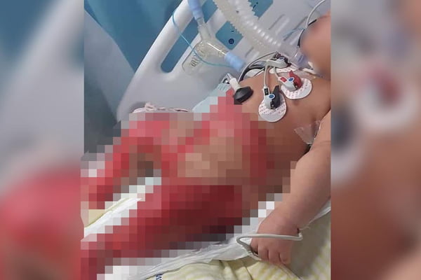 Bebê tem queimaduras fortes em hospital