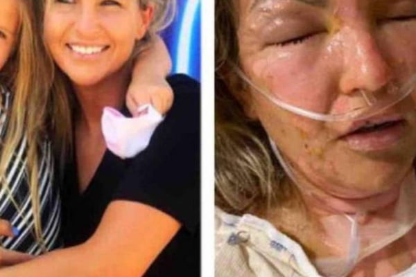 A americana Kate Wise se queimou gravemente após tentar acender uma vela com as mãos com álcool em gel