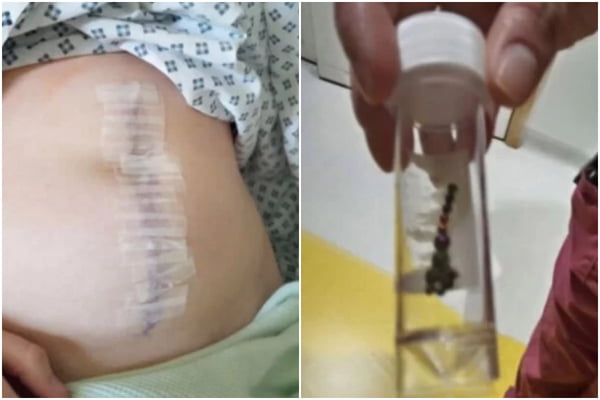 Jovem perde parte do intestino após desafio com piercing no TikTok