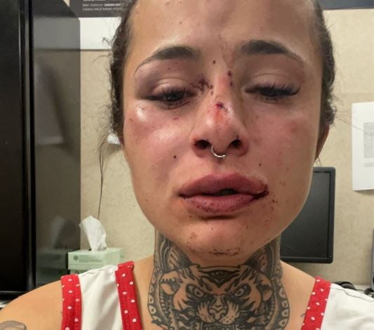 Mulher foi agredida pelo namorado e posta nas redes sociais pedido de ajuda