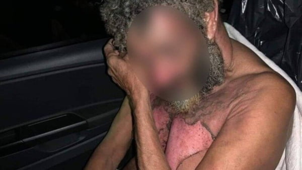Homem em situação de rua é queimado enquanto dormia em Nova Iguaçu