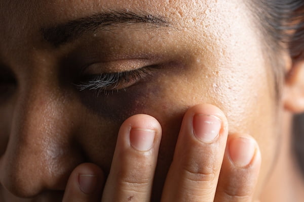 Foto colorida mostra olho roxo de mulher agredida fisicamente. A mulher etá com mão no rosto e olhar cabisbaixo