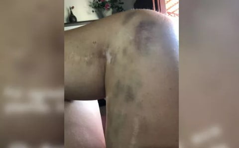 Perna da médica Eny Godinho ficou com vários hematomas após ser agredida em hospital de Monte Alegre de Goiás