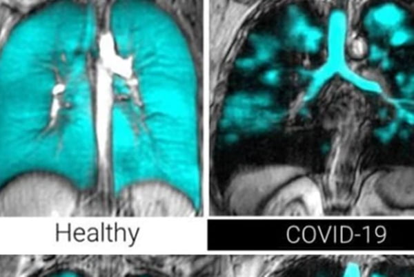 Técnica especial de imagem mostra pulmão saudável (esquerda) e após COVID-19 com sequelas (direita), onde pode-se perceber manchas pretas - Metrópoles