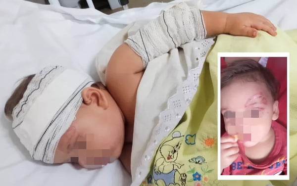 Bebê é queimado enquanto mãe cozinhava com álcool em Goiás