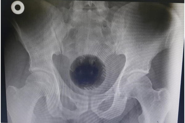 Radiografia mostra bola presa em reto de homem após o mesmo tentar curar hemorróidas inserindo-a no ânus - Metrópoles