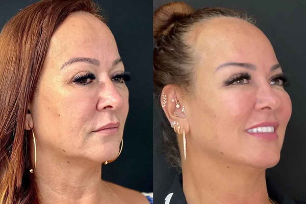 Fotos do antes e depois dos procedimentos de Nadine Gonçalves