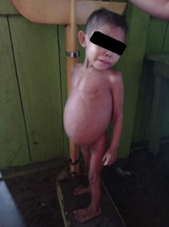 Crianças indígenas Yanomami ficaram sem medicamentos por conta de esquema de corrupção