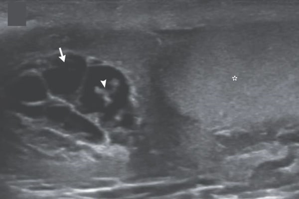 Foto em preto e branco de um ultrassom do saco escrotal com vermes se movimentando