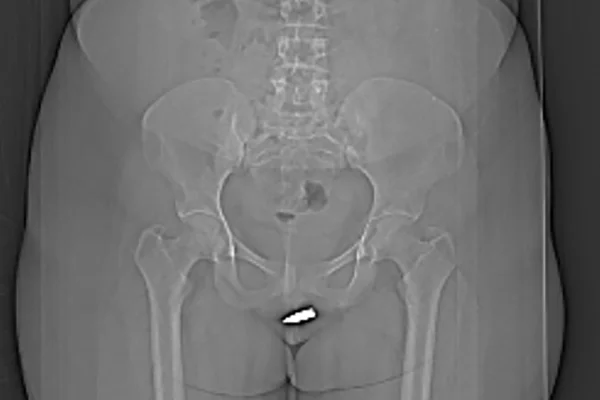 Imagem de radiografia mostra bala perdida alojada em clitóris de mulher - Metrópoles