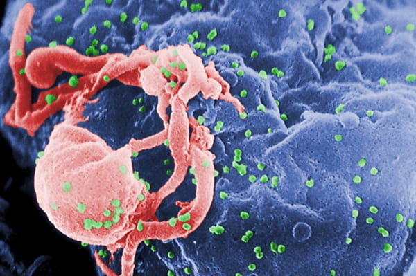 Imagem colorida de microscópio mostra o vírus HIV infectando linfócitos - Metrópoles