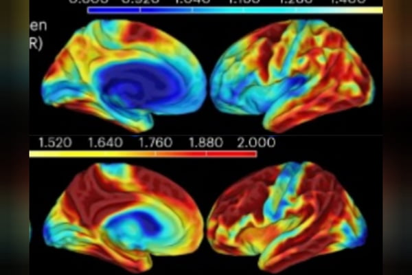 Ressonância magnética revela cérebro do homem imune ao alzheimer (no topo) mais preservado que o de outras pessoas com sua mesma condição gen[ética (abaixo) - Metrópoles