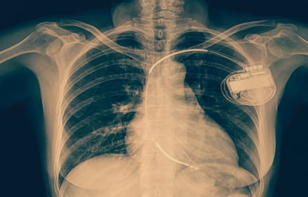 Paciente tem mini desfribilador implantado em estudo inédito contra mortes súbitas em infartos Britânico de 53 anos passou por operação que poderá mudar parâmetros da cardiologia e evitar mortes súbitas CDIS