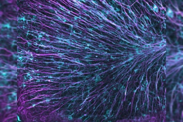 Exames de imagem permitiram avaliar a recuperação da mielina em pessoas com esclerose múltipla que foram tratadas usando o antialérgico