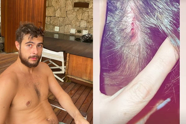 Ator Rafael Vitti sofre acidente ao surfar e mostra ferimentos