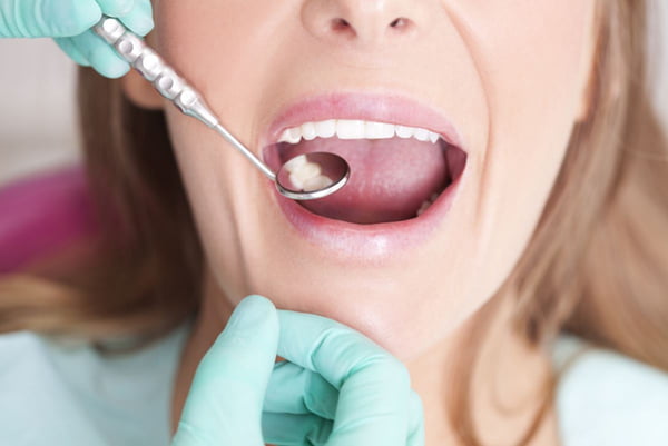 Foto de mulher com boca aberta sendo examinada por dentista - Metrópoles - cárie