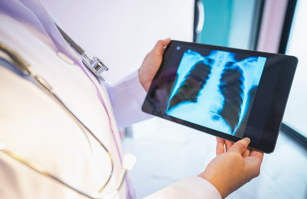 Médico observa exame de imagem de um pulmão - tuberculose - Metrópoles