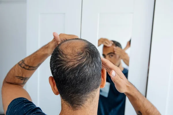 Foto colorida de homem careca olhando no espelho para calvície e perda de cabelo - Metrópoles