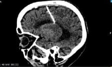 Foto mostra radiografia de idosa que viveu 80 anos com uma agulha no cérebro