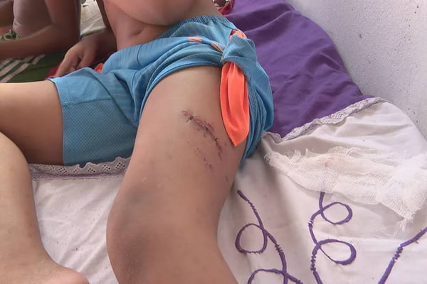 Criança de 9 anos atacada por pit-bull em Sobradinho