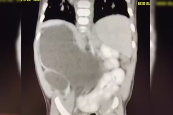 imagem de raio-x de menina com quatro rins, moradora de Formosa (GO)