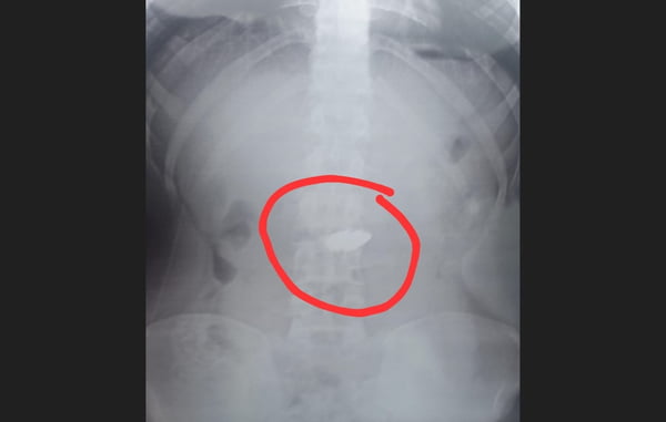 foto em preto e branco de raio-X de adolescente aponta presença de corrente de ouro no estômago - Metrópoles