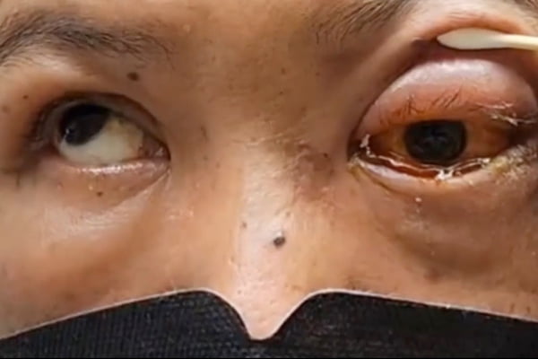 Homem em exame oftalmológico - Metrópoles