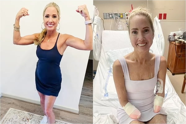 Duas fotos. Na primeira, mulher faz pose de fisiculturista; na segunda ela está sentada em cama de hospital sorrindo - Metrópoles