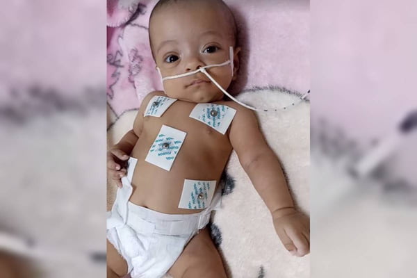 bebê com tubos de intubação em cama de hospital