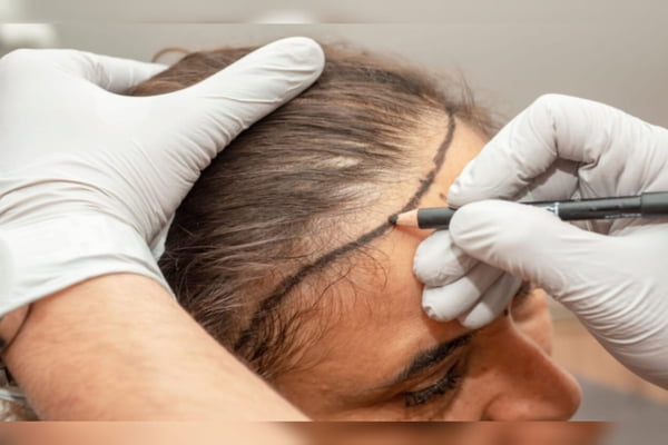 Foto mostra pessoa com luvas traçado linha na testa de mulher com queda de cabelo para transplante capilar