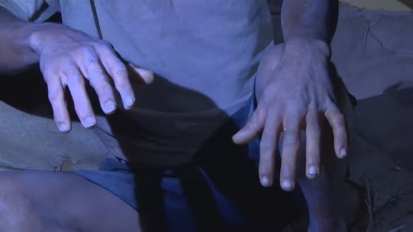 Imagem colorida das mãos de um dos trabalhadores resgatados em pedreira clandestina. Ele e outros três homens recebiam pedras de crack por trabalho em pedreira de Taquara (RS) - Metrópoles