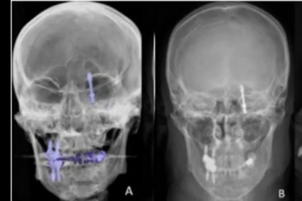 Reprodução mostra exames de imagem feitos que revelam parafuso de implante dentário no cérebro de paciente - Metrópoles
