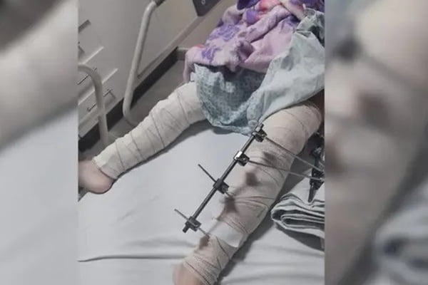 Imagem colorida mostra criança que teve perna operada de forma errada - Metrópoles