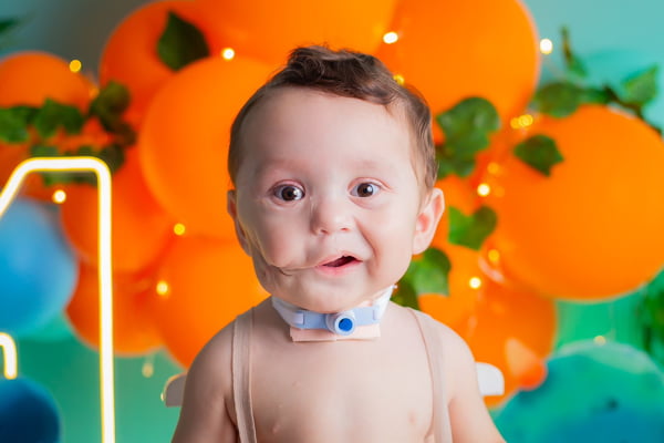 Foto mostra bebê Brian Demjenski Pereira, que teve tumor epignathus - Metrópoles