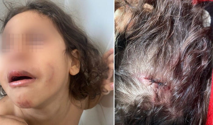 montagem com duas fotos de uma criança com a cabeça e rosto machucados