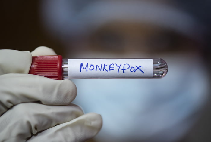 Pessoa segurando fraco com adesivo com a palavra Monkeypox- Metrópoles