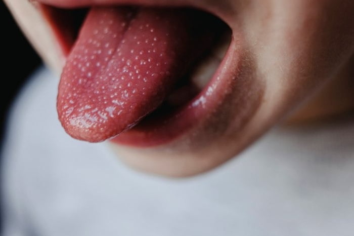 criança com a língua cheia de caroços, semelhante a um morango - Metrópoles
