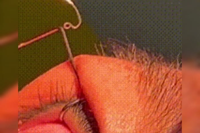 Imagem colorida mostra verme sendo retirado de olho de mulher com vermelhidão