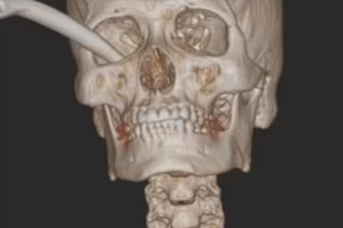 Imagem de ressonância mostra um crânio com objeto de plástico saindo do olho - Metrópoles